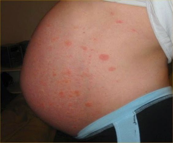 pengaruh herpes zoster pada ibu hamil